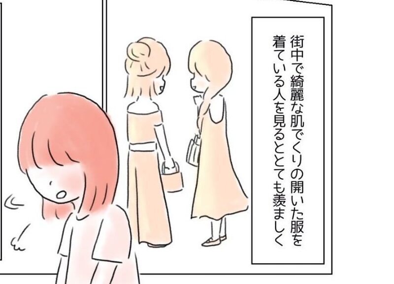 背中に大きなアザがある女性。勇気を出して“背中の開いたドレス”と着ると…→男性が声をかけてきて！？